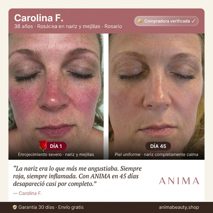 Crema Natural ANIMA - Chau Rosacea (Reduce la rojez en 7 Días)